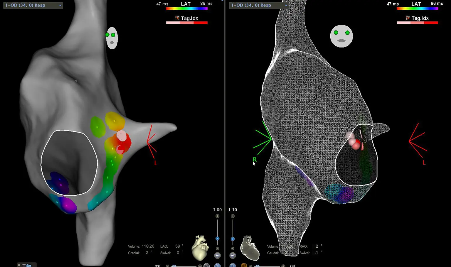 Ablation de tachycardies jonctionnelles Ablation de tachycardies jonctionnelles