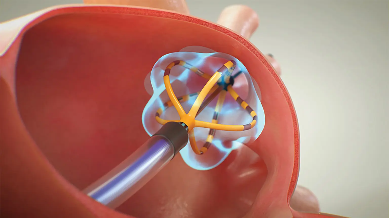 Ablation de fibrillation atriale Ablation de fibrillation atriale