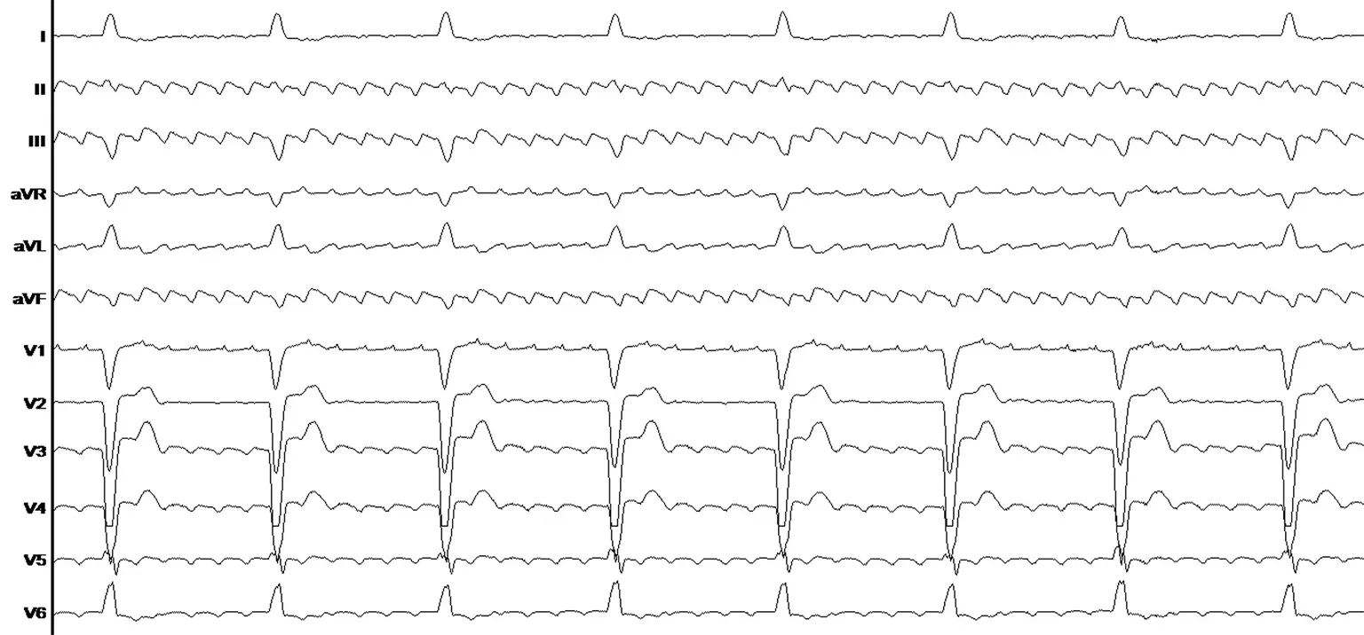 Ablation du flutter auriculaire Ablation du flutter auriculaire