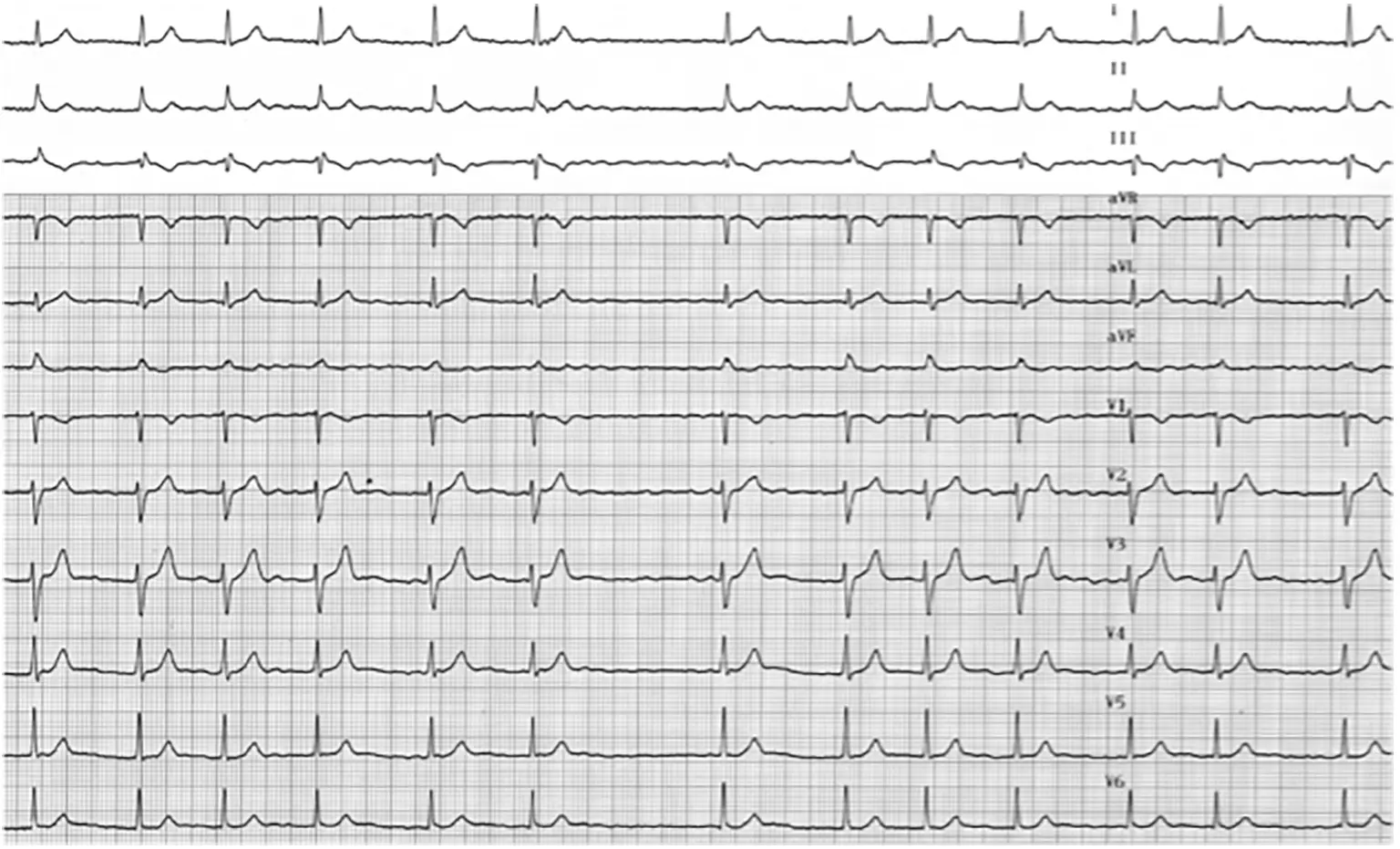 Cardioversion Cardioversion