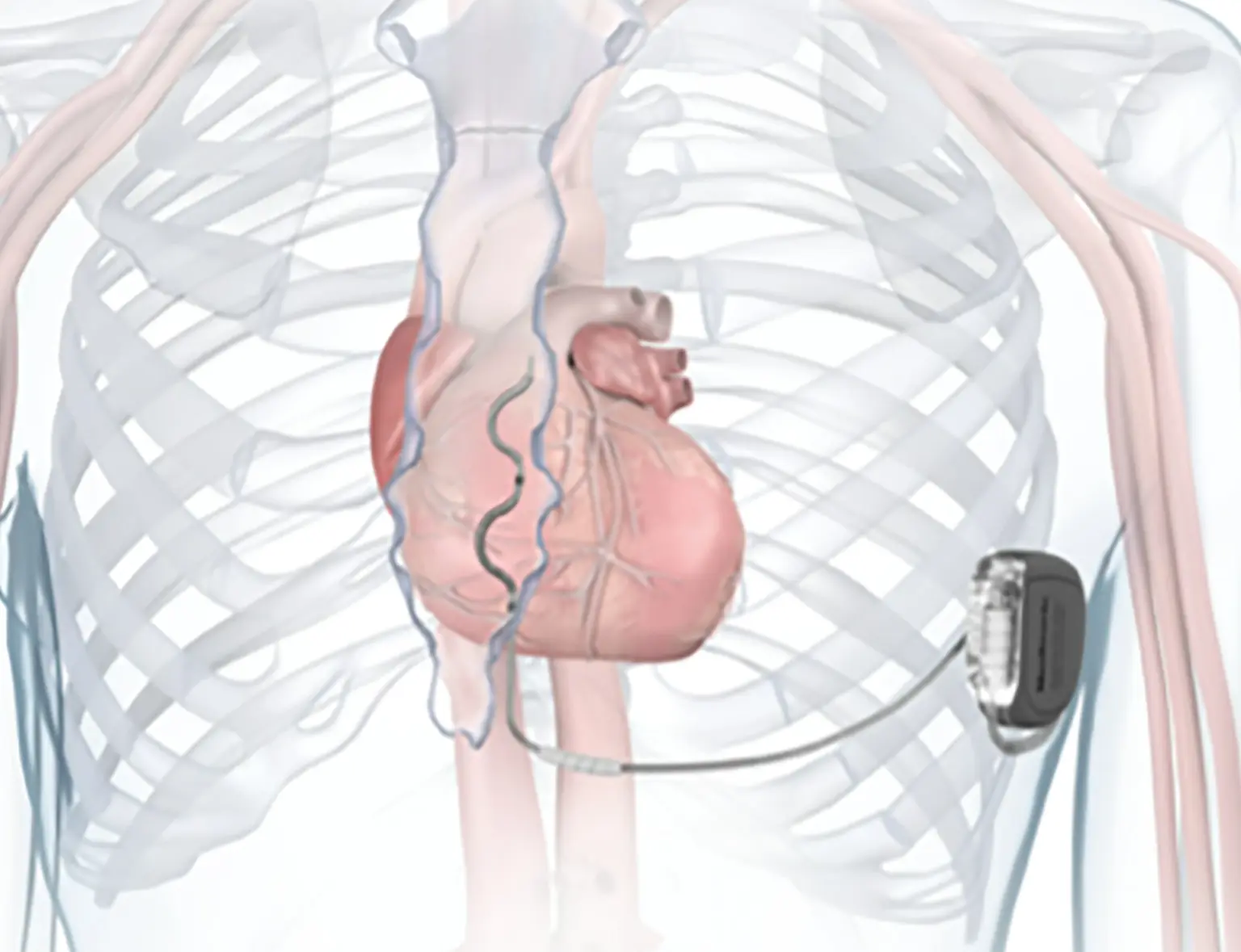 DAI Extravasculaire DAI Extravasculaire