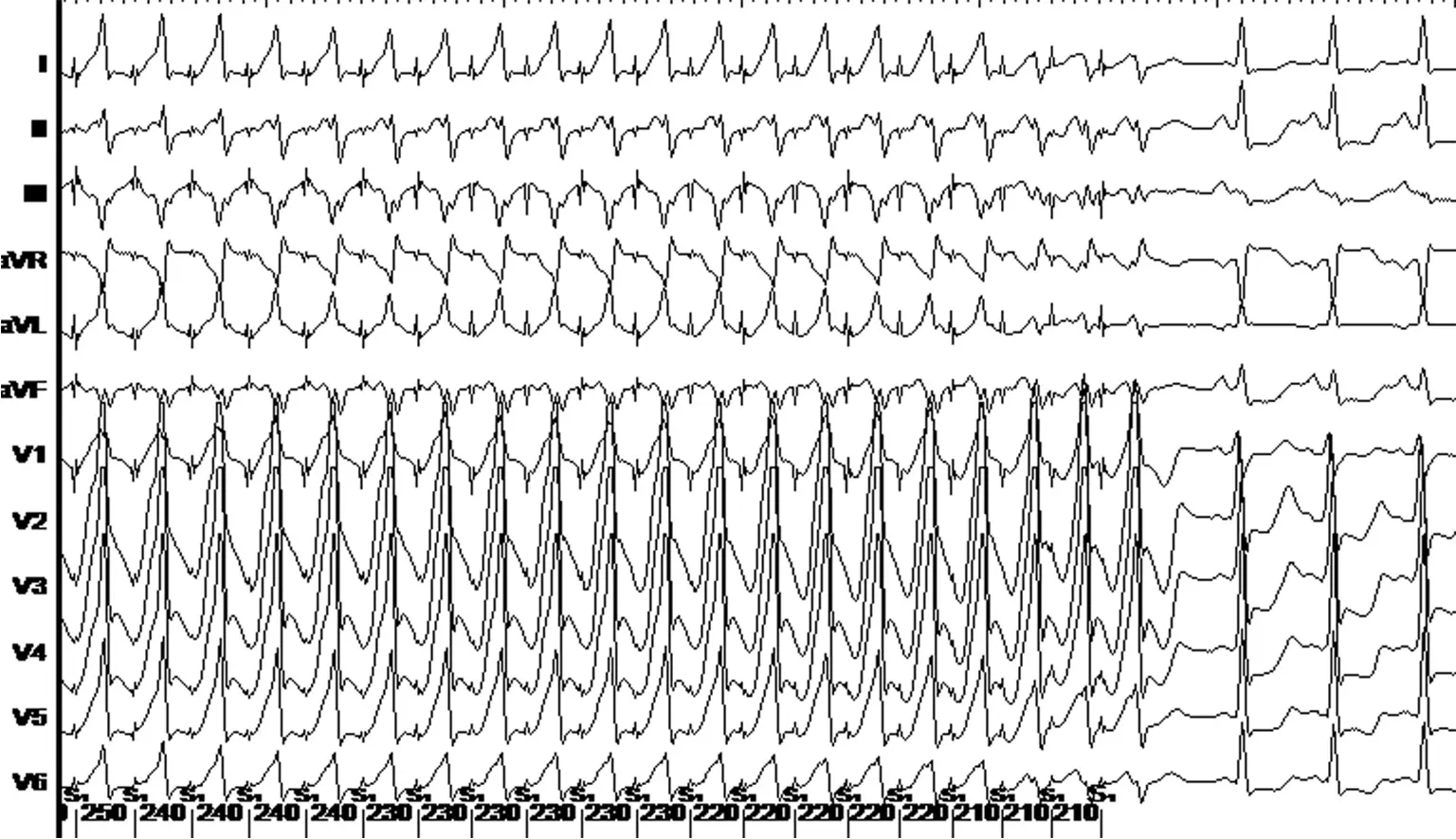 ECG de tachycardies jonctionnelles ECG de tachycardies jonctionnelles