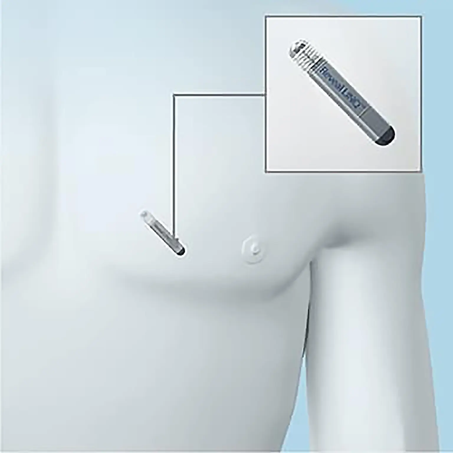 Holter implantable Holter implantable